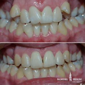 Teeth Straightening Before and After Photos