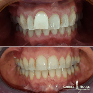 Invisalign® Lincoln Teeth Straightening Before and After Photos
