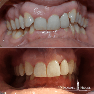 Invisalign® Lincoln Teeth Straightening Before and After Photos