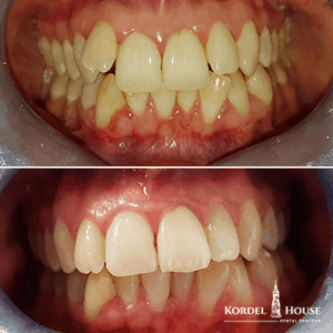 Invisalign® Lincoln Teeth Straightening Before and After Photos
