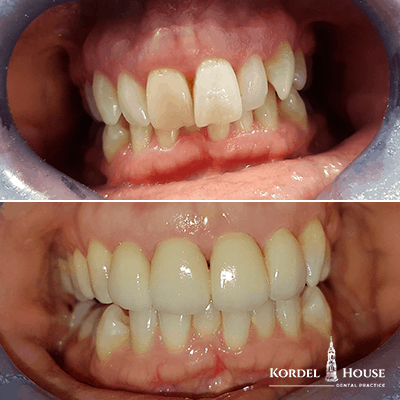 Invisalign® Lincoln Teeth Straightening -Before and After Photos