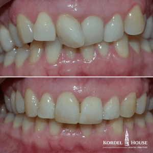 Invisalign® Lincoln Teeth Straightening Before and After Photos