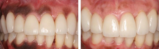 Laser Gum Depigmentation