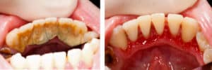 Gum Disease Treatment Lincoln