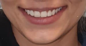 Invisalign Lincoln-Teeth Straightening
