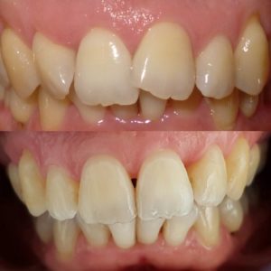 Before and After Invisalign Photos