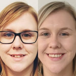 Invisalign® Lincoln