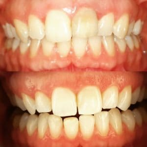 Invisalign Lincoln Before and After Photos