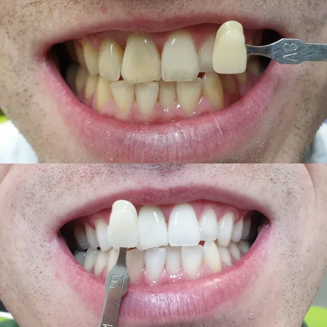 Teeth Whitening In Lincoln Kordel House Dental Practice