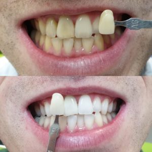 Teeth Whitening in Lincoln